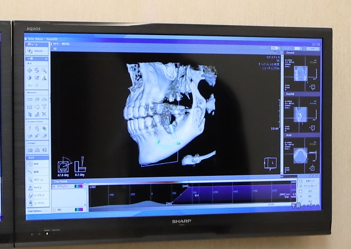 先進的なインプラント治療、歯周病治療などはCTが不可欠