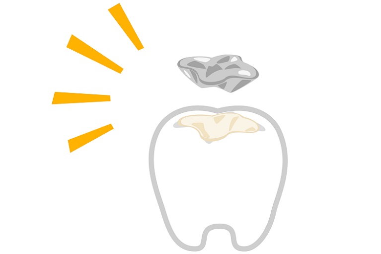 奥歯の詰め物・銀歯が取れるのはなぜ？